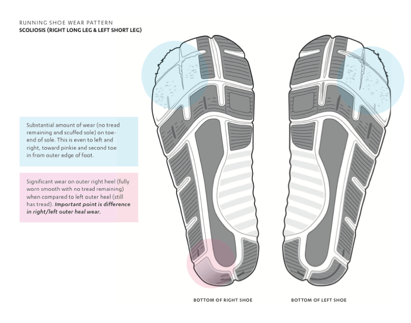 supination shoe wear pattern